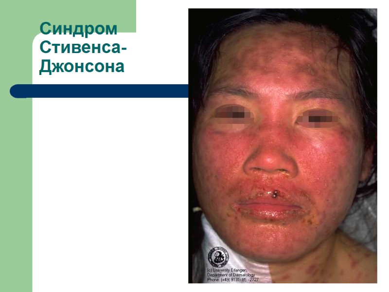 Синдром  Стивенса- Джонсона